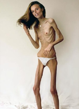 http://kmu.ucoz.ru/PICTURES/Anorexia/07.jpg